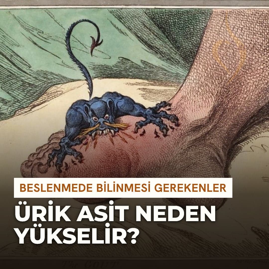 James Gillray'in 1799 tarihli "The Gout" gravürü — ayağı pençeleyen gut iblisi tasviri